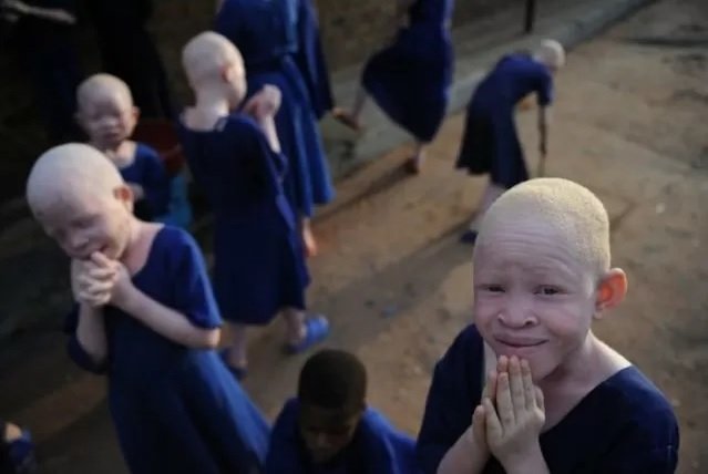 Albinos