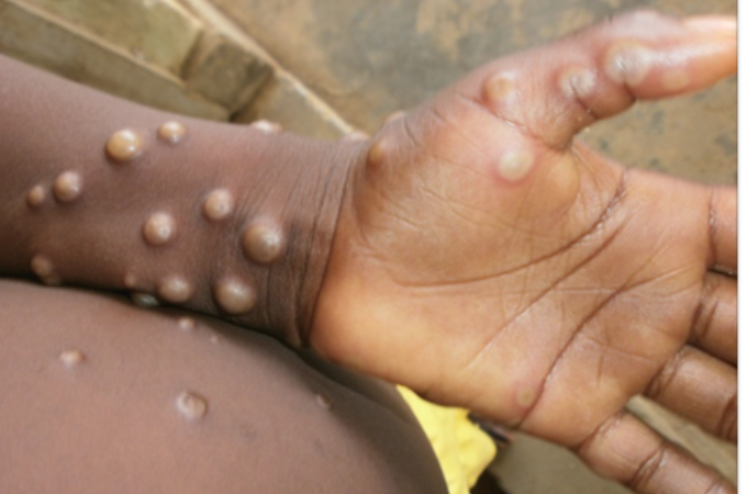 Mpox