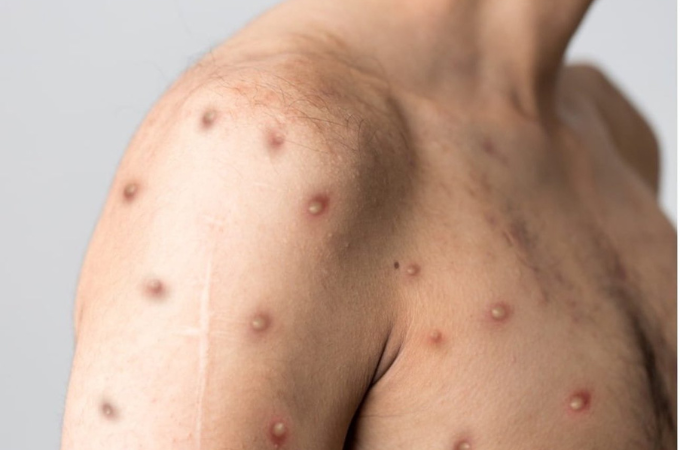 Mpox
